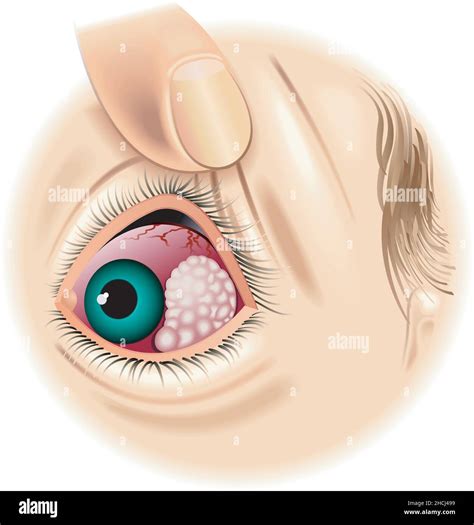 Eye tumor Cut Out Stock Images & Pictures - Alamy