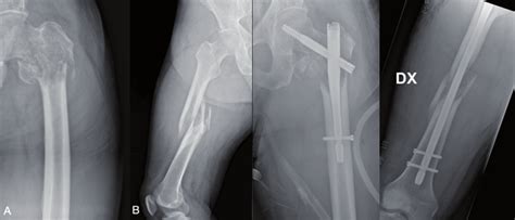 Anterior-posterior RX showing pertrochanteric fracture of left femur ...