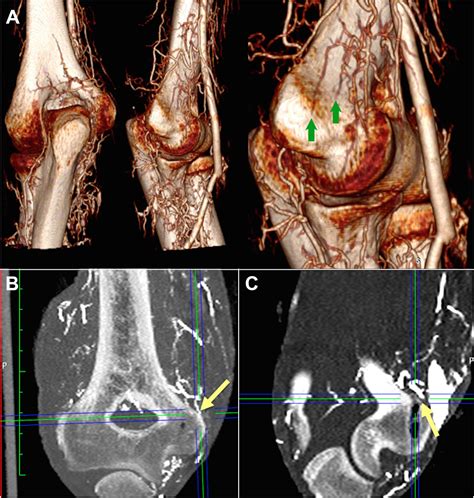 Osseous Vascularity Of The Medial Elbow After Ulnar Collateral Ligament Reconstruction A