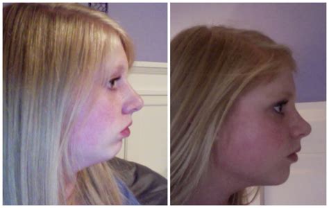 Katies Double Jaw Surgery Day 38 Beforeafter Profile