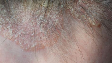 Scalp Eczema Psoriasis: Differences, Pictures And Treatment, 42% OFF