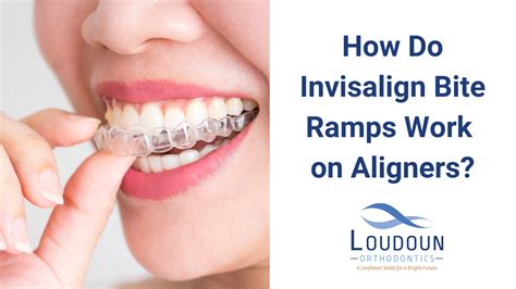 Deep Bite Invisalign