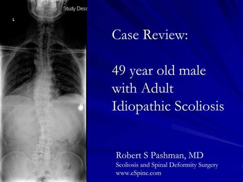 Case Review 33 49 Year Old Dancer Presented With Idiopathic Scoliosis