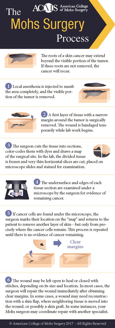 Overview Of Mohs Surgery Dermatology Blog