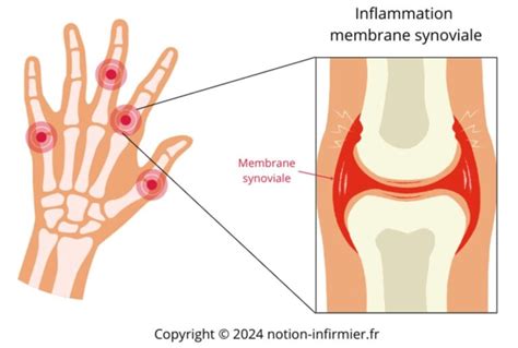 Fiche IDE Polyarthrite rhumatoïde Notion Infirmier