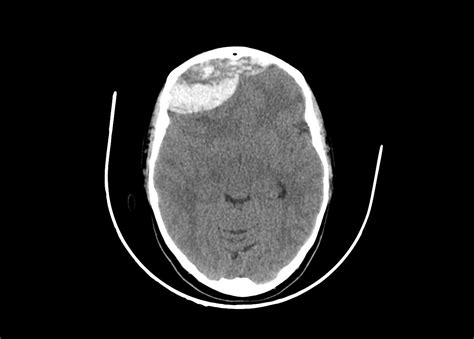 Spontaneous Epidural Hematoma In Sickle Cell Disease Image