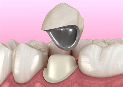 Dental Crown Recementation Atlas Dental Toronto Dentist