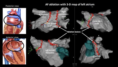 Procedure AF Ablation - Melbourne Heart Group