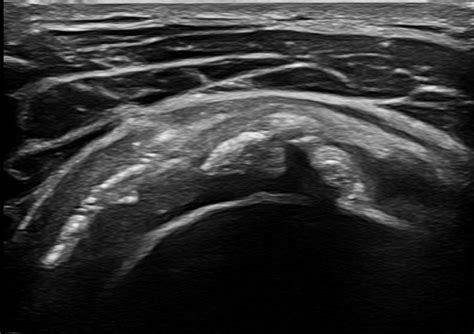 Shoulder Ultrasound