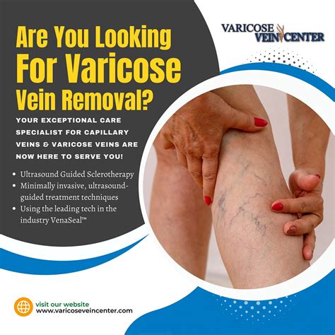 Varicose Vein Treatment And Spider Vein Treatment By Varicose Vein Center Medium