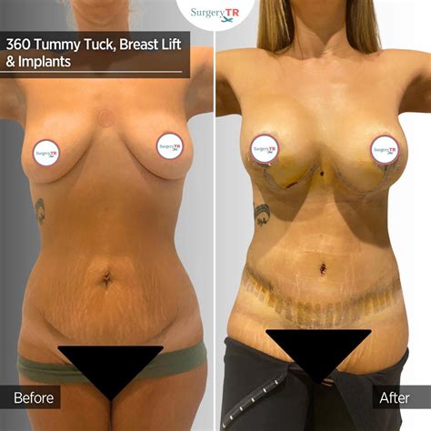 Tummy Tuck In Turkey Abdominoplasty SurgeryTR