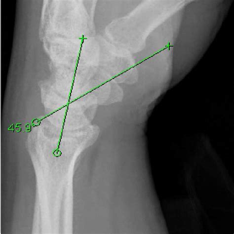 Measurement Of Scapholunate Angle 3 Ulnar Variance Figure 3 A Line