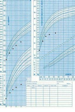 Russell Silver Syndrome Growth Chart