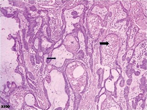 Ameloblastoma Histology