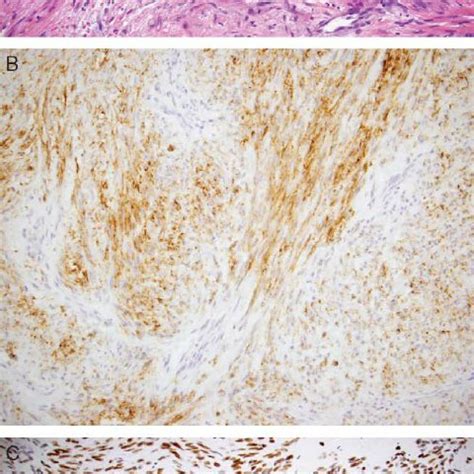 Immunohistochemical Profiles of Normal Ovarian Stroma and Ovarian... | Download Scientific Diagram