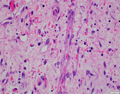 Pathology Outlines Undifferentiated Embryonal Sarcoma