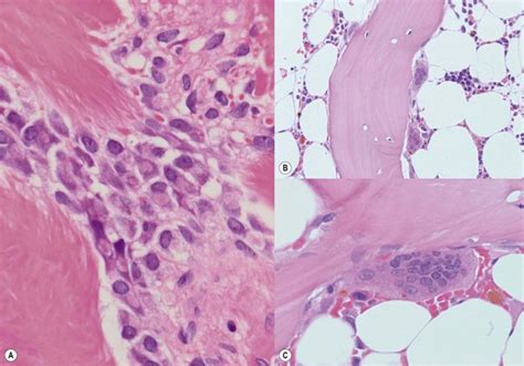 Essential Thrombocythemia And Primary Myelofibrosis Basicmedical Key