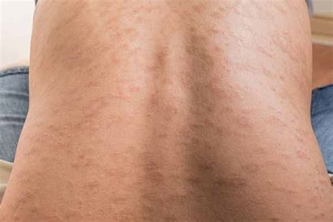 Orticaria Cause Sintomi Rimedi Naturali E Come Riconoscerla Foto Porn