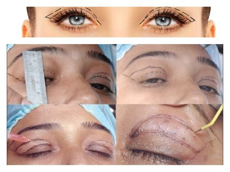 Blefaroplastia Recomendaciones y Guía 2019