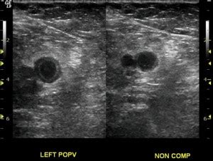 Venous Thrombosis Ultrasound