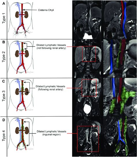 Classification Of The Para Aortic Lymphatic Perfusion Pattern The