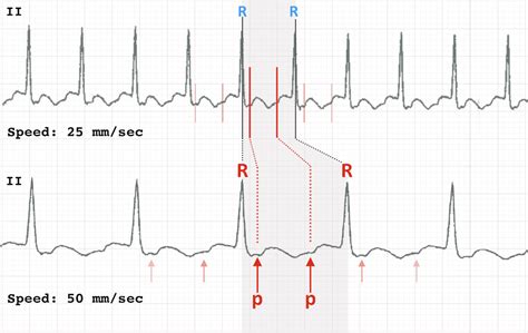 Ecg Rate Interpretation • Litfl Medical Blog • Ecg Library Basics