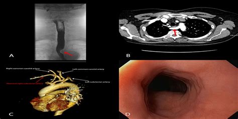 S2128 Dysphagia Lusoria A Rare Cause Of Dysphagia Official Journal