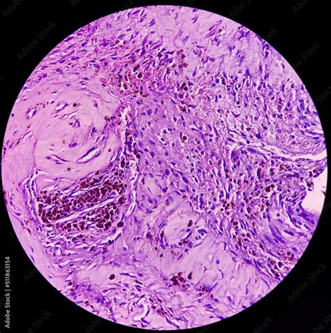 Photomicrograph Of Schwannoma A Benign Soft Tissue Tumor Enlarged