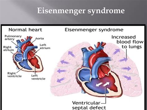 Ventricular Septal Defect With Nursing Management Ppt