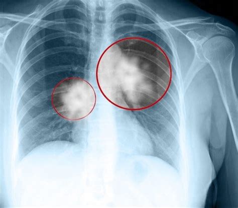 Advanced or metastatic small cell lung cancer treatment