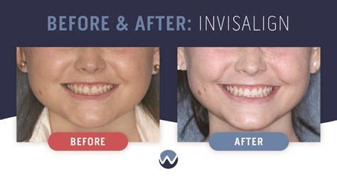 Clear Aligners Before After See How They Transform Smiles Woodhill