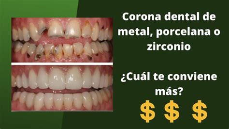 Gu A Definitiva Para Entender El Precio De Una Funda Dental Cu Nto