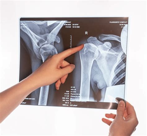 20 Acromial End Images, Stock Photos, 3D objects, & Vectors | Shutterstock