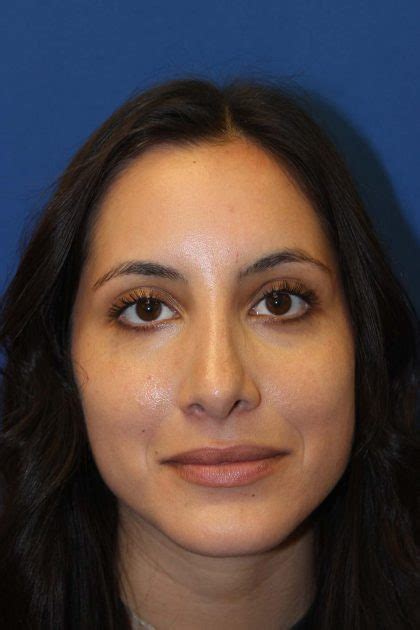 Patient Rhinoplasty Before And After Photos La Jolla Plastic