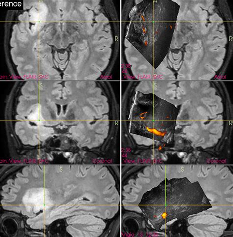 Frontiers Current Limitations Of Intraoperative Ultrasound In Brain