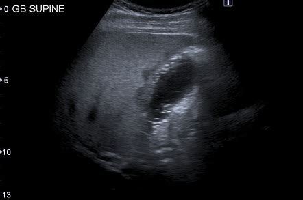 Champagne sign (gallbladder) | Radiology Reference Article | Radiopaedia.org