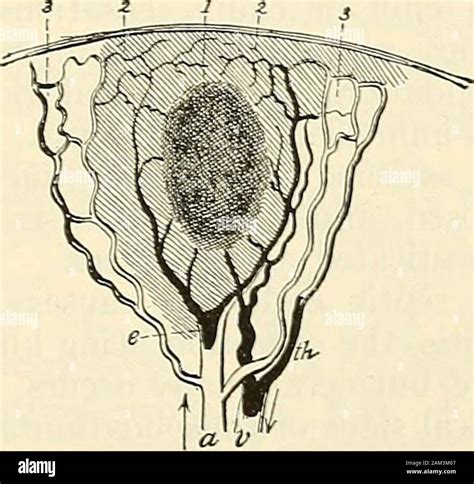 Pale Infarct Kidney