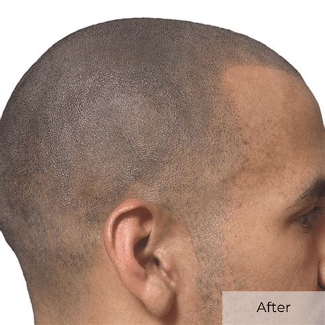 Scalp Micropigmentation Gallery We Grow Hair Indy