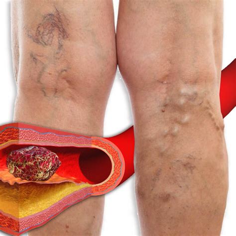 Why Is Varicose Veins Dangerous Vascular Center Angiolife®