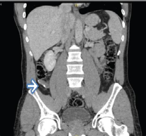 Minimally Invasive Surgery For Resection Of Appendiceal Mucocele A