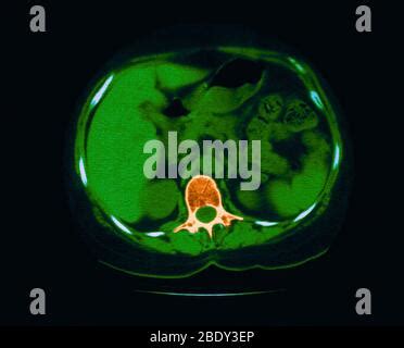 Axial Computed Tomography Of The Chest Lung Window In A Known Patient