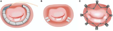 Frontiers Direct Percutaneous Mitral Annuloplasty In Patients With