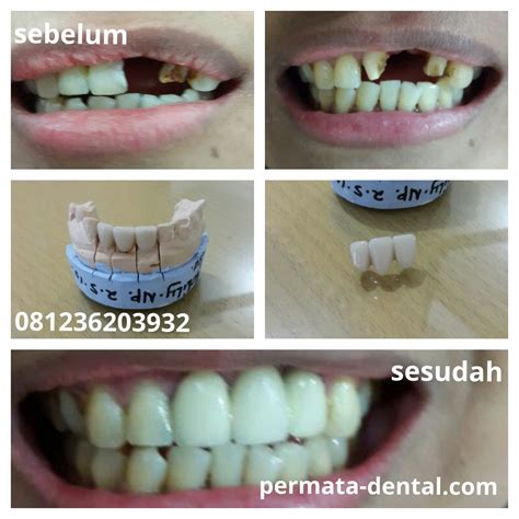 mimpi gigi palsu 2d 2