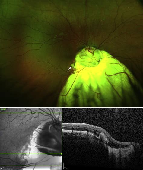 Association Of Pediatric Choroidal Neovascular Membranes At The Temporal Edge Of Optic Nerve And