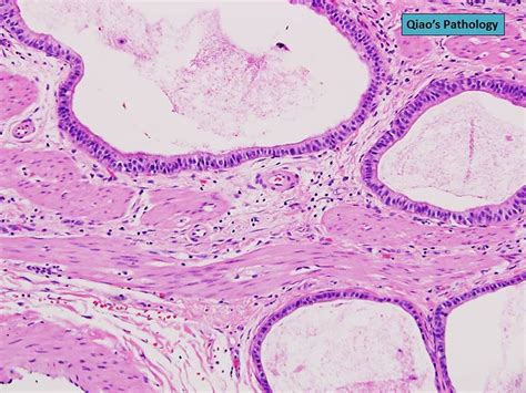 Qiao S Pathology Adenomyomatosis Of The Gallbladder A Photo On