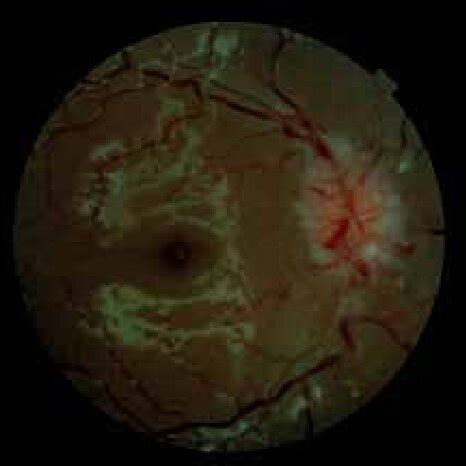 Right eye -papillary edema | Download Scientific Diagram