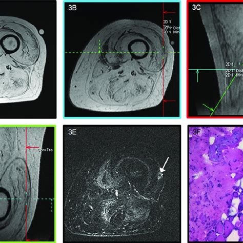 Mri Guided Biopsy Of The Right Vastus Lateralis A The Exact Needle