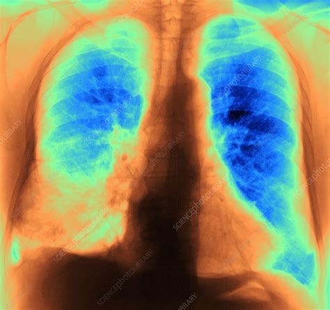 Bacterial Pneumonia X Ray Stock Image M240 0541 Science Photo Library