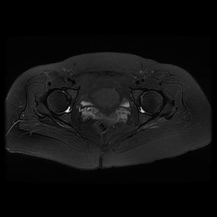 Subgluteus Minimus Bursitis Image Radiopaedia Org