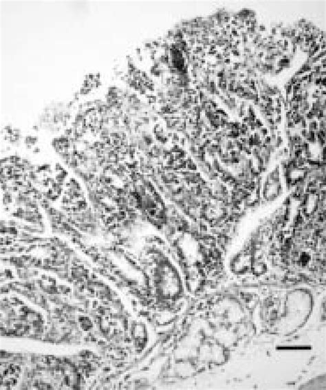 Neutrophilic Infiltration Of The Duodenal Mucosa With Atrophy And